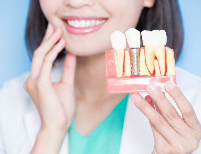 Benefits of Dental Implants