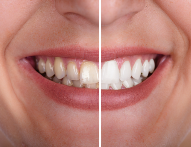 Benefits of Teeth Whitening