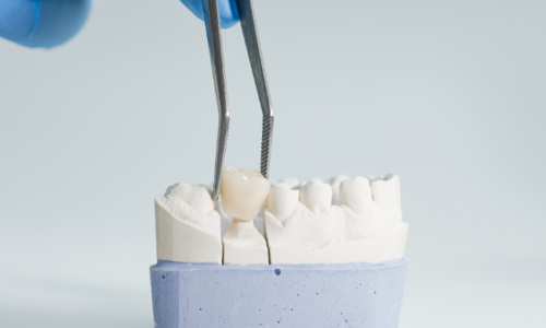 What Are Dental Crowns