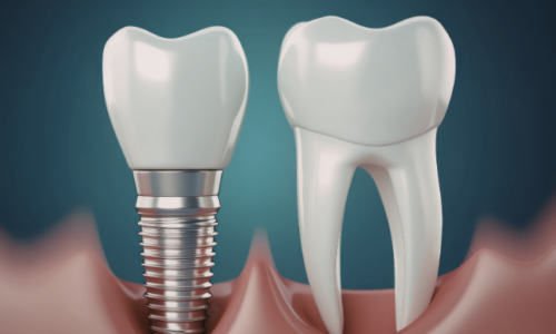 What Are Dental Implants What Are Dental Implants