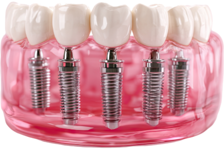 What Is All-on-4 Implants