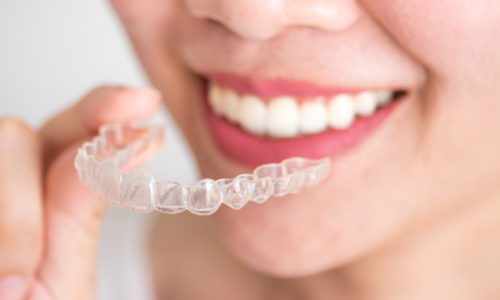 What Is Invisalign What Is Invisalign