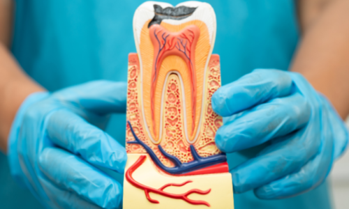 What Is Root Canal Therapy What Is Root Canal Therapy