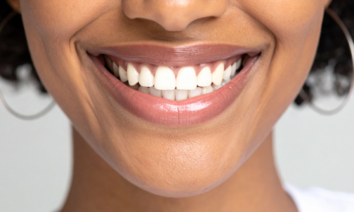 What Is Smile Makeover What Is Smile Makeover