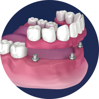 Permanent Dentures - Landing Page